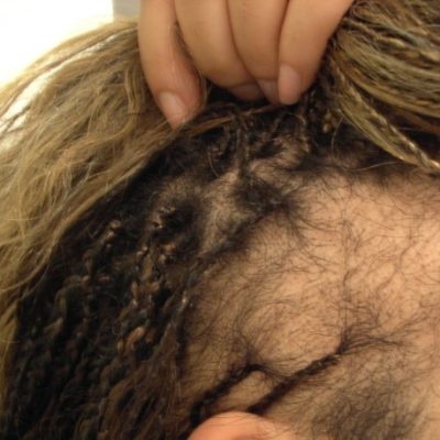 Trakční alopecie způsobená těsným účesem