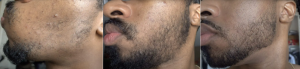 Minoxidil na bradu